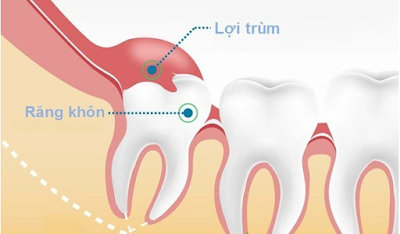 Đau răng khôn mọc lệch điều trị thế nào?