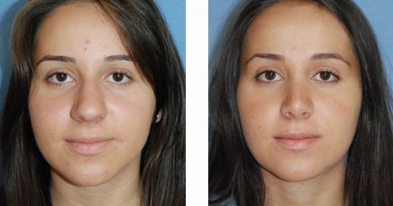 MEDİKAL ESTETİK DOLGU BOTOX TOPTAN ÜRÜN SATIŞI ADRESİNİZE KARGO