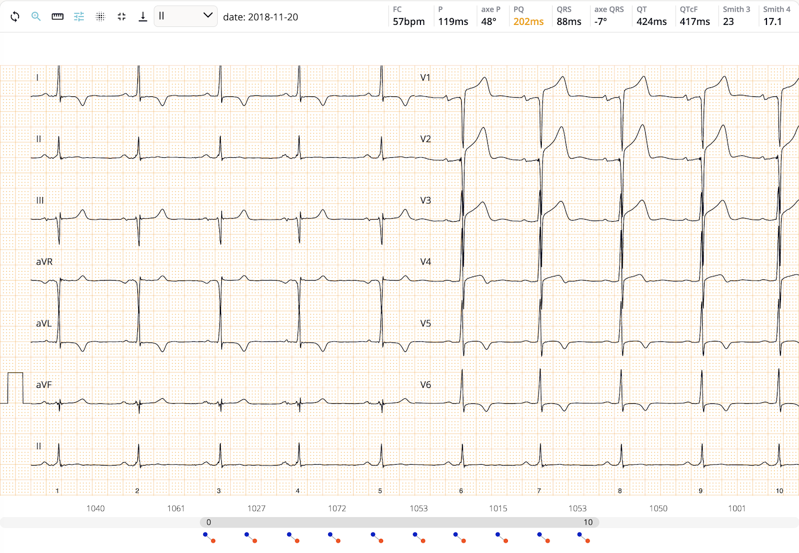 Кардиограмма v1. Кардиограмма v1. V1 отведение экг. Субэпикардиальная ишемия на экг. V5 v6 экг.