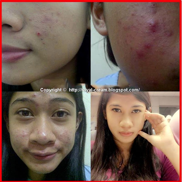 Royal Beauty Cream (Malaysia) Royal Expert White Cream Customer Feedback