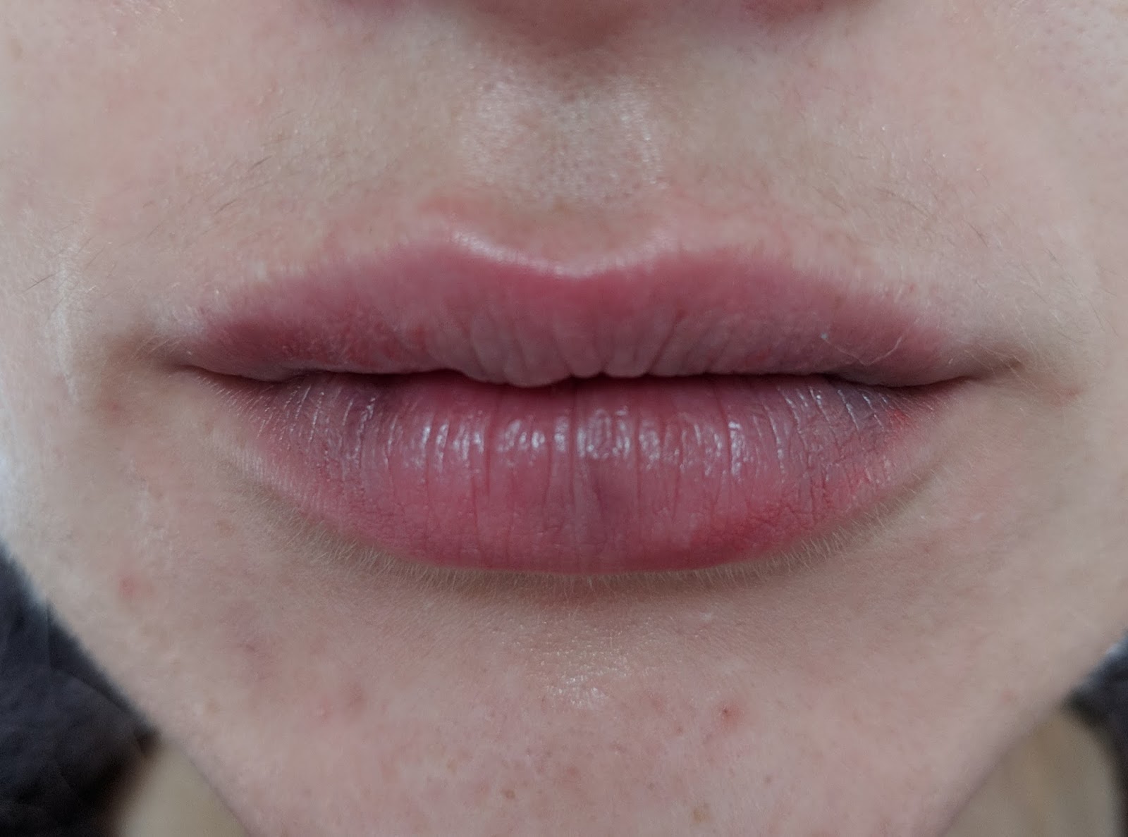 I got lip fillers my experience Lauren Loves Blog