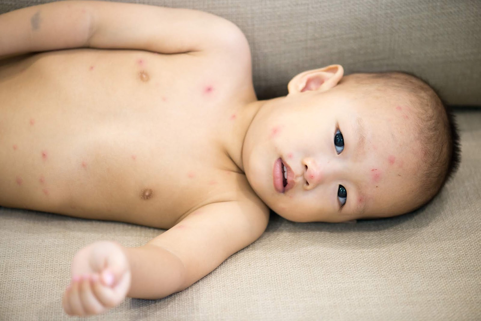 水痘—— 为什么采取预防措施 对您的孩子来说很重要