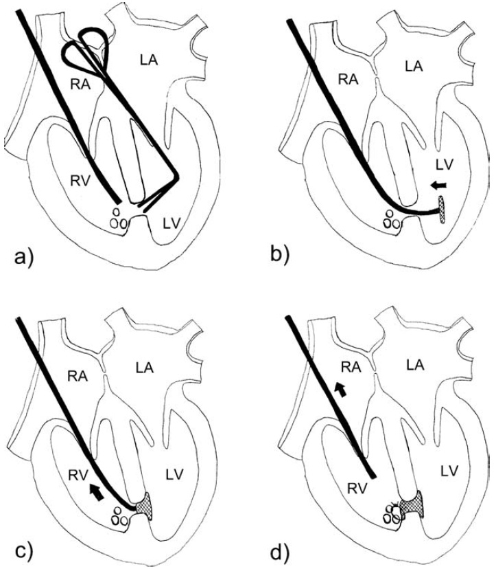 Journal Club Hybrid Procedure Intraop. VSD closure