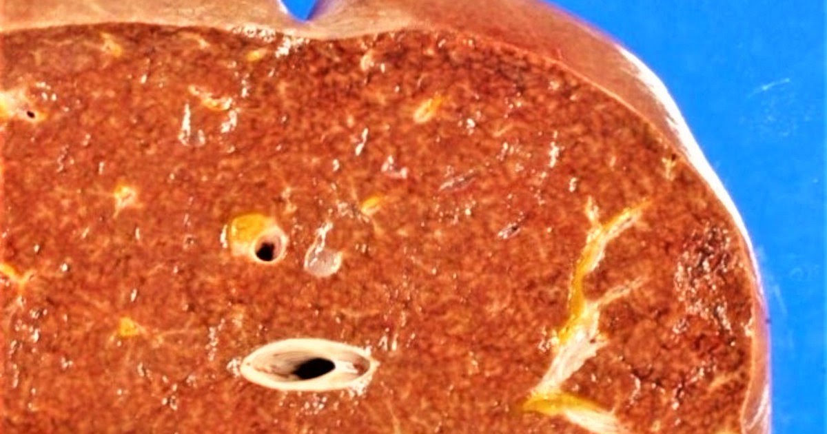 Nutmeg Liver Definition, Symptoms, Causes, Treatment Health Care Tips