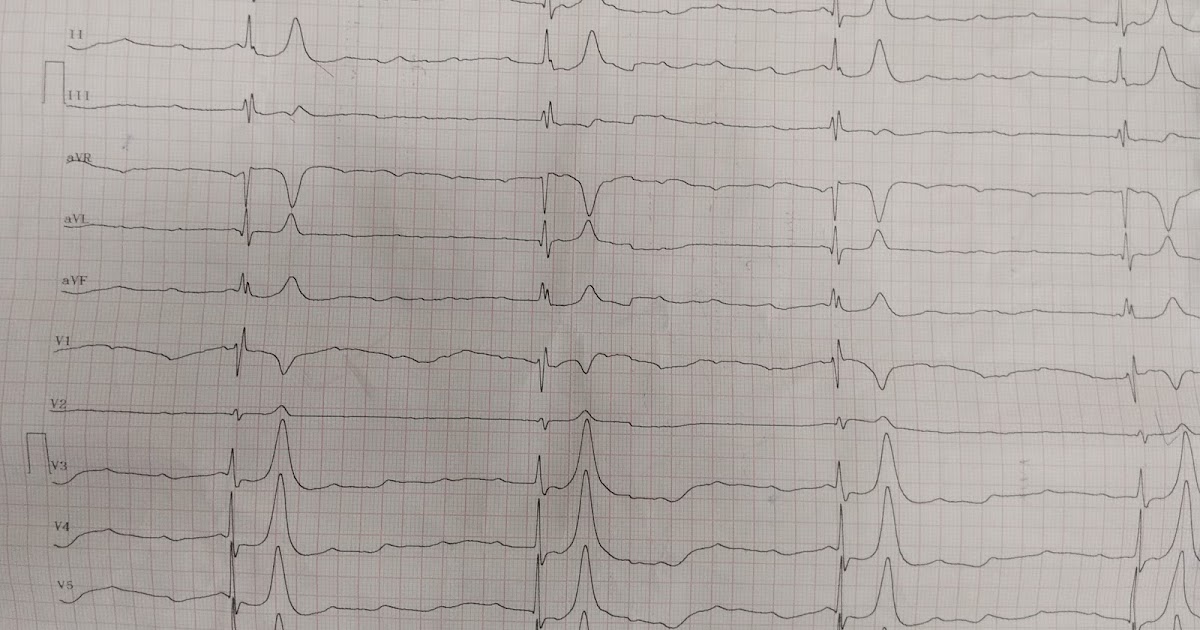 Cardiology window Hyperkalemia induced high grade AV block