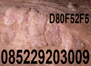 Obat Kutil Kelamin Obat Kutil Kelamin