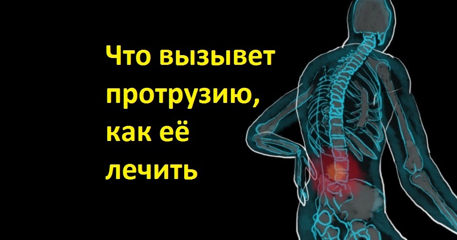 Протрузии межпозвонковых дисков поясничного отдела позвоночника. Протрузия l5 l6. Протрузия диска позвоночника. Протрузия поясничного отдела позвоночника. Секвестрированная грыжа позвоночника l5-s1.