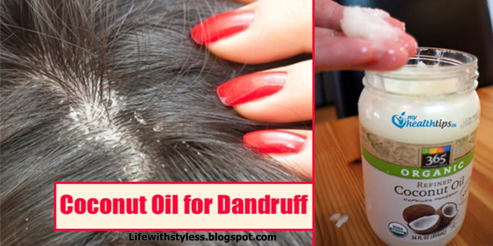 How to Use Coconut Oil for Dandruff Life With Styles