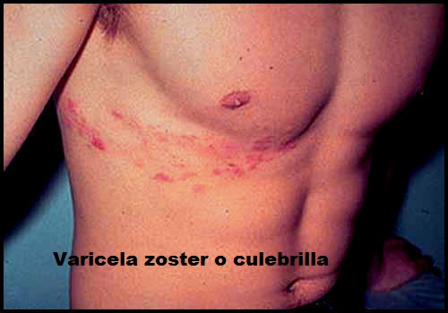 Doctor tengo culebrilla me voy a morir!!! varicela o herpes zoster Doctor tengo culebrilla me voy a morir!!! varicela o herpes zoster