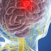 Tout ce que vous devez savoir sur le cancer du cerveau - Traitement, Symptômes, Diagnostic et plus encore.