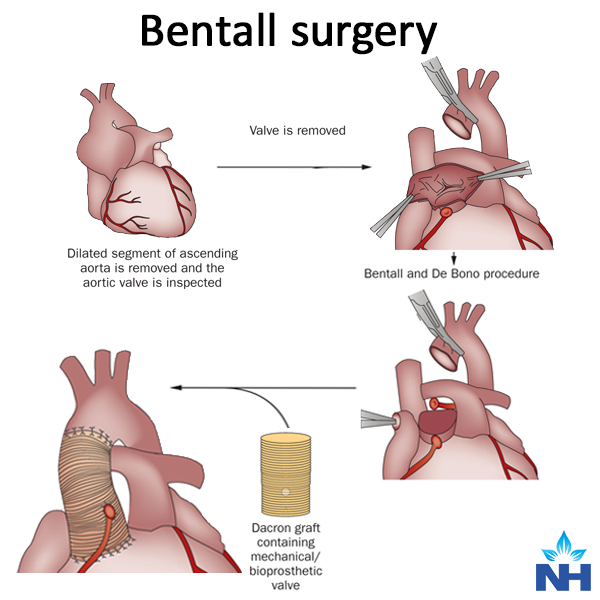 Aortic Dissection Bentall Procedure Aortic Dissection