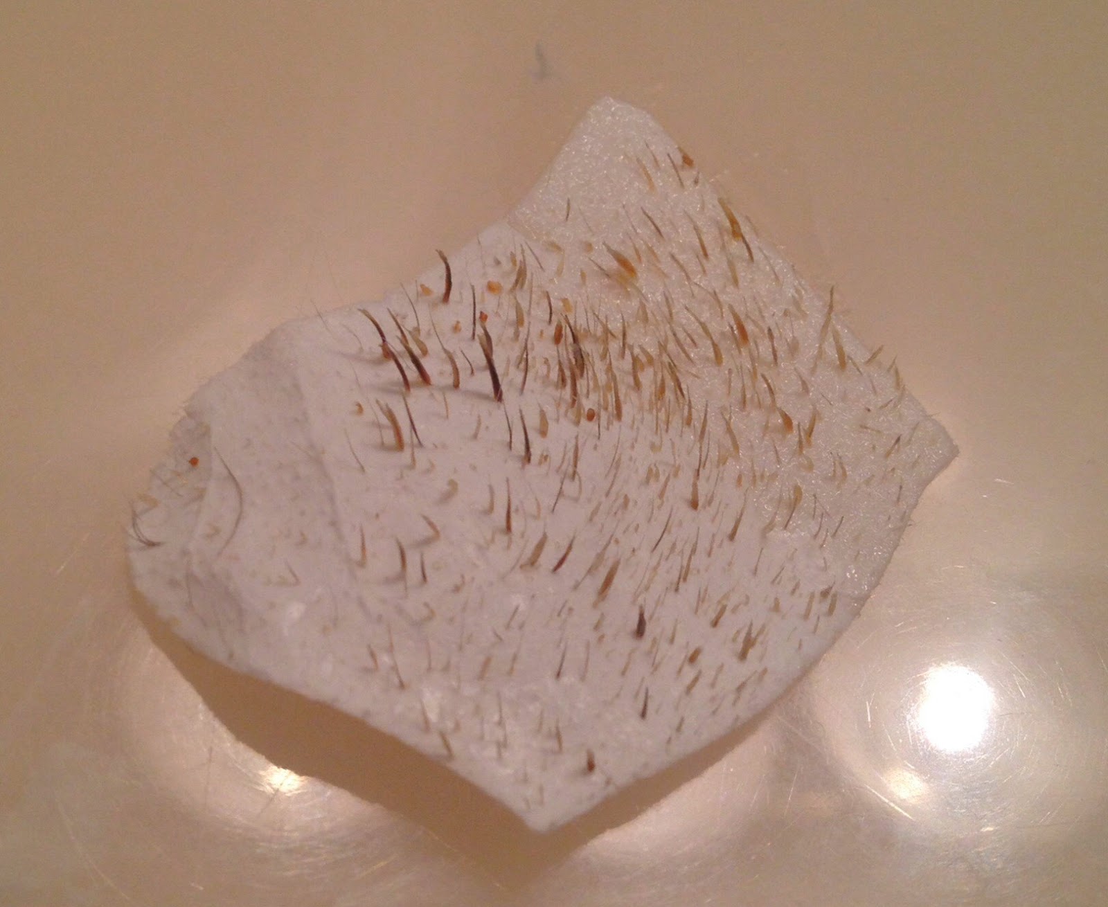 Mr. ZIT Most 10 Shocking Popping Photo ! (Zits , Pimples