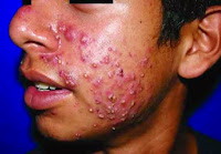 Obat Jerawat Batu Obat Jerawat Batu