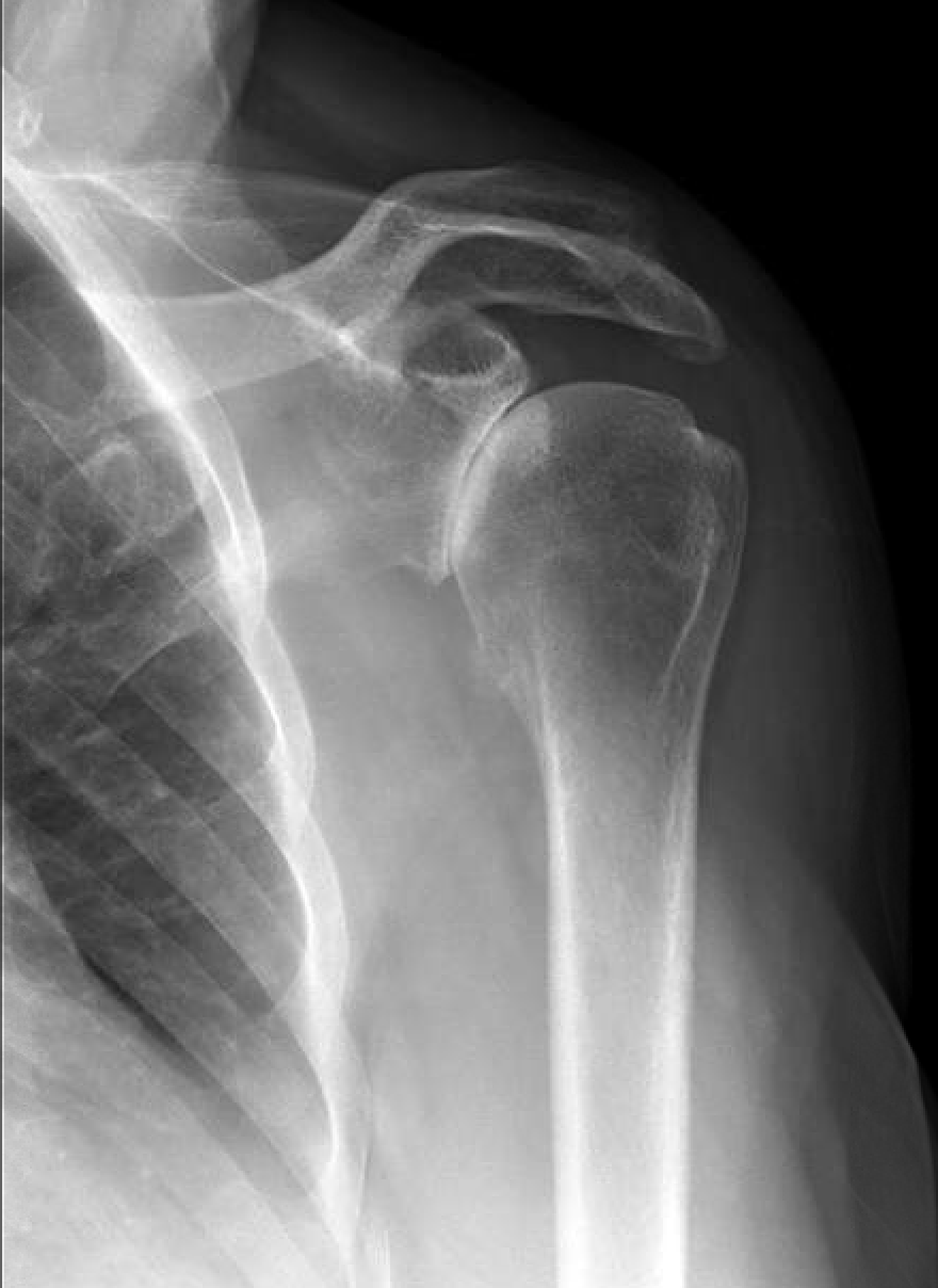 Shoulder and Elbow Surgery Total shoulder replacement after proximal