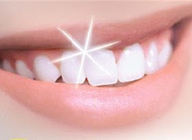 blanqueamiento dental, carillas estéticas, carillas de porcelana, sonrisa perfecta, snowdent, clínica dental, 