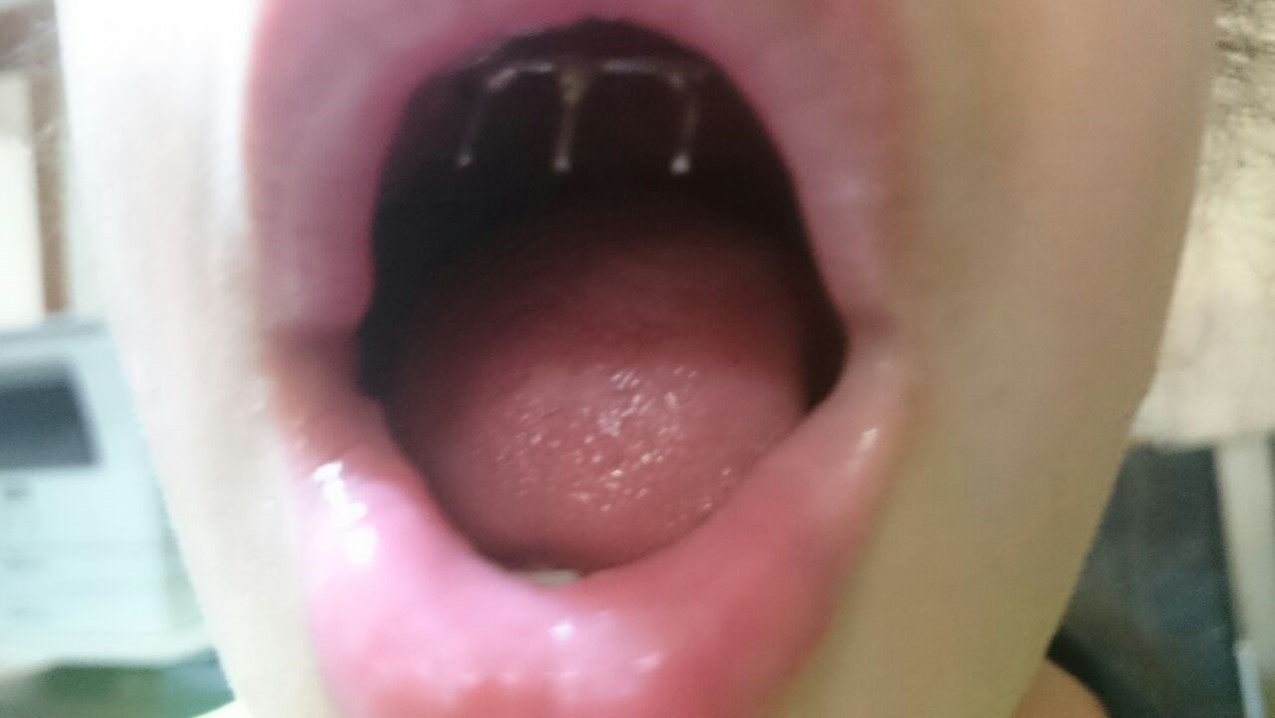 قضم الأظافر عند الطفل