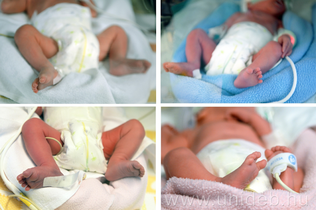 Harminc év után újra négyes ikrek születtek tegnap a Debreceni Egyetem Szülészeti és Nőgyógyászati Klinikáján. A babákat 12 fős orvoscsoport segítette a világra.