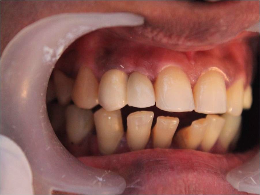 Smile designing along with dental implants with zirconium crown in INDIA