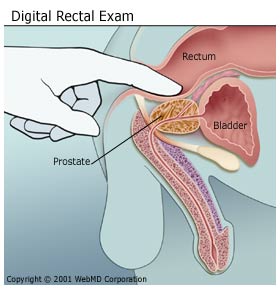 examen de la próstata tacto rectal