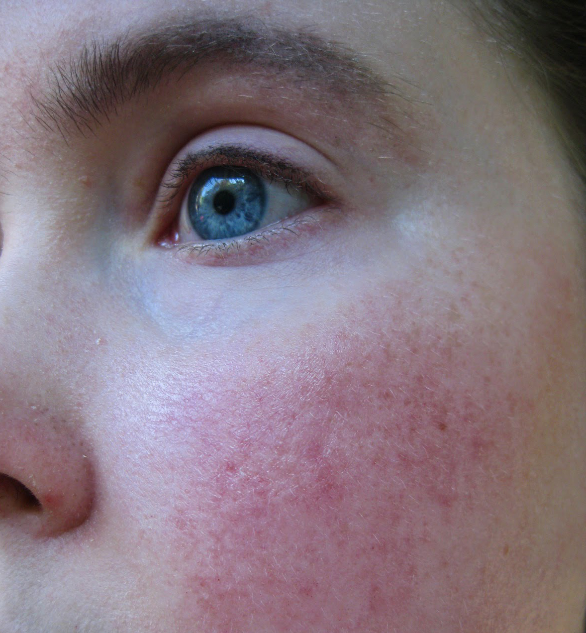 Scarlet Letters, dealing with vascular rosacea, face flushing, burning