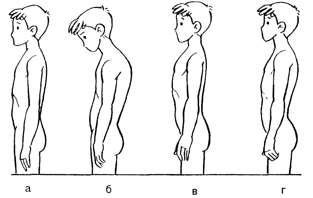 нарушения осанки рисунки