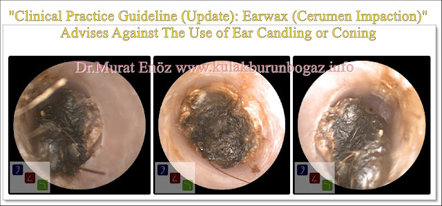 Cerumen and cerumen impaction - Treatment of cerumen impaction - The guideline advising against the use of ear candling - What is the earwax (cerumen)?