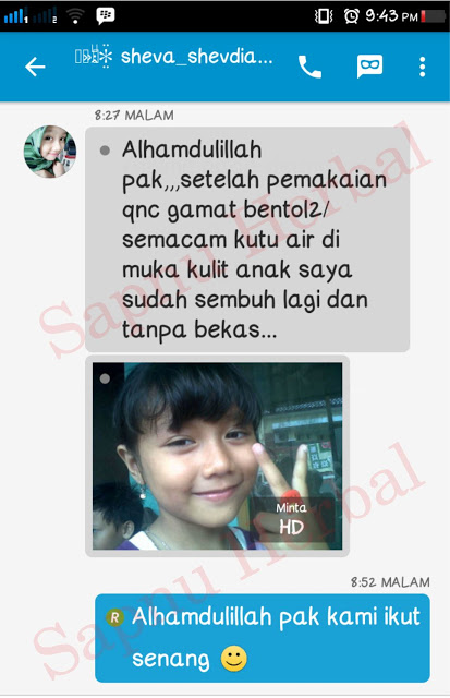 Ahlinya Obat Gatal ~ Testimoni Ahlinya Obat Gatal ~ Testimoni