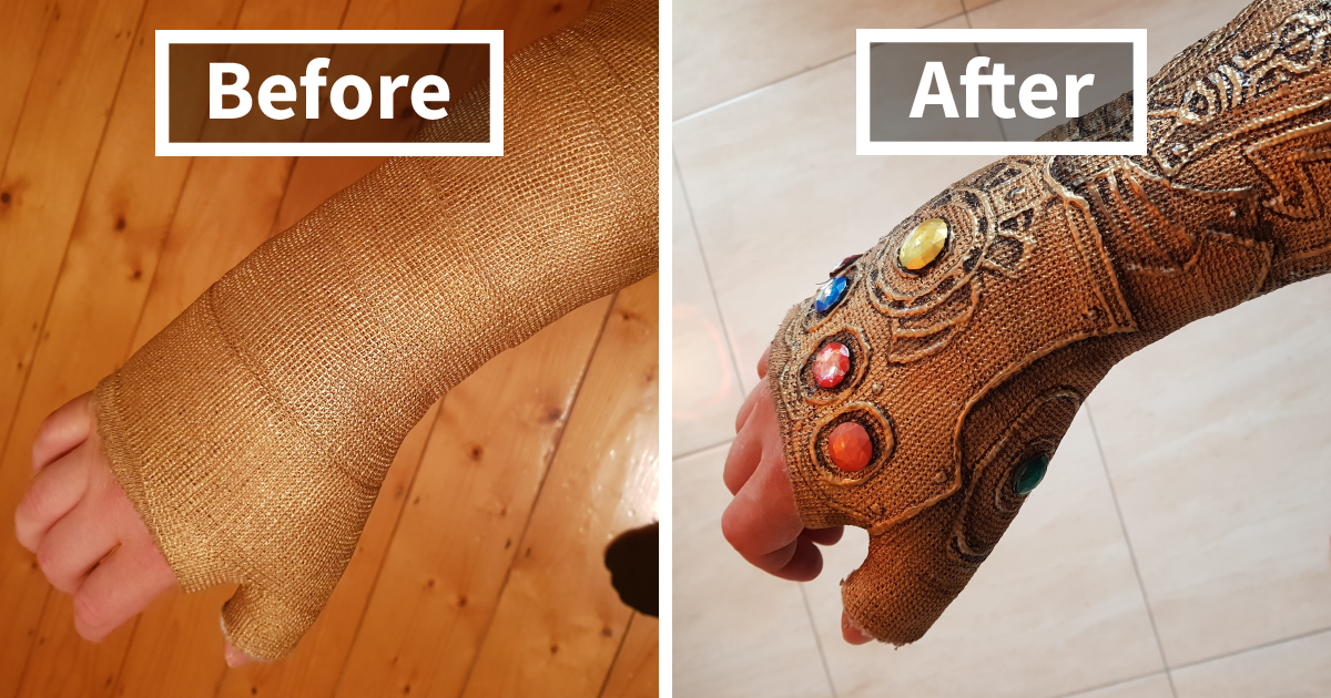 After This Guy Broke His Wrist, He Decided To Transform His Cast Into The Infinity Gauntlet Of Thanos