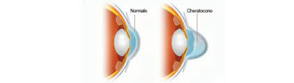 Cheratocono: che cos'è e come si cura