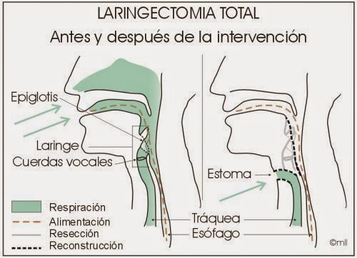 Asociación Barcelonesa de Laringectomizados: ¿Qué es una laringectomía?