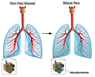 Cara Menghilangkan Cairan Dalam Paru Paru Secara Alami Cara Menghilangkan Cairan Dalam Paru Paru Secara Alami