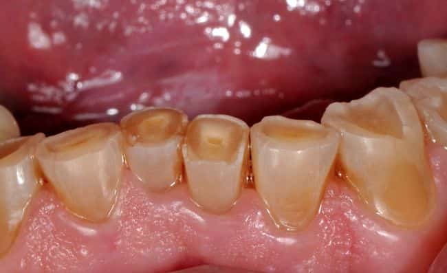 Desgaste Dental