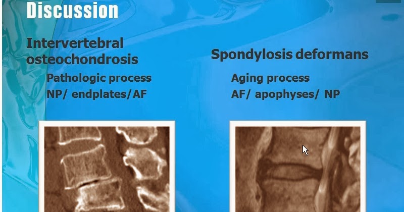 spondylosis osteochondrozis artrózisának kezelése