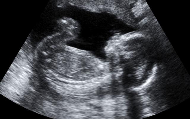 adindanurul متى يظهر الجنين في كيس الحمل في اي اسبوع