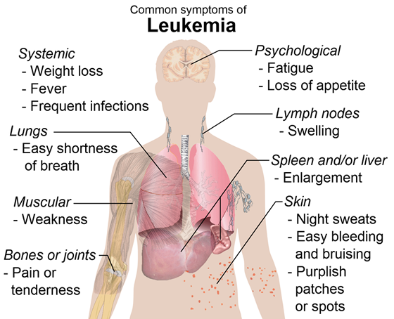 Common symptoms of leukemia