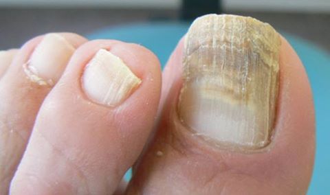 Que medicinas se puede beber del hongo de las uñas
