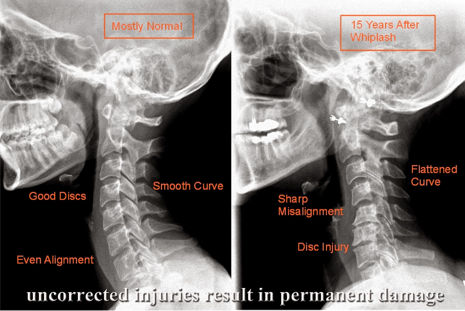 If You Were Recently In A Car Accident Whiplash Why Does My Neck Hurt