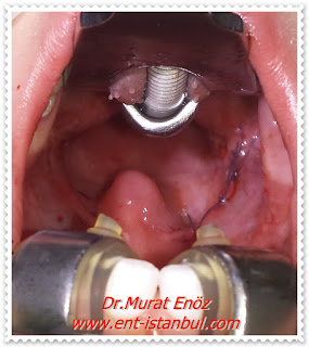 Tonsillectomy in Istanbul