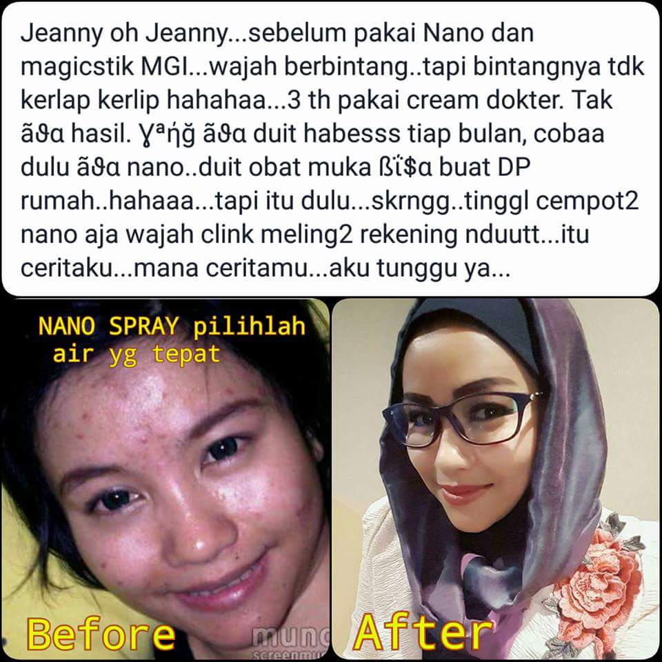 MCI surabaya: [NANO SPRAY] Jerawat hilang, makin cantik hanya dengan