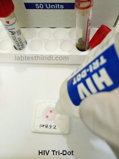 HIV - test Add 5 drop Buffer Solution