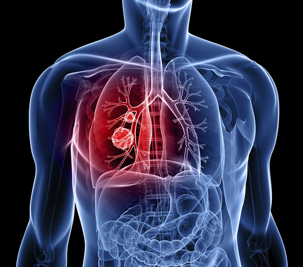 Lung Cancer