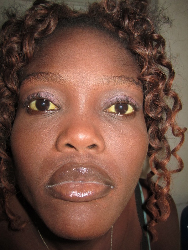 Dr. Anna in Haiti: ogen