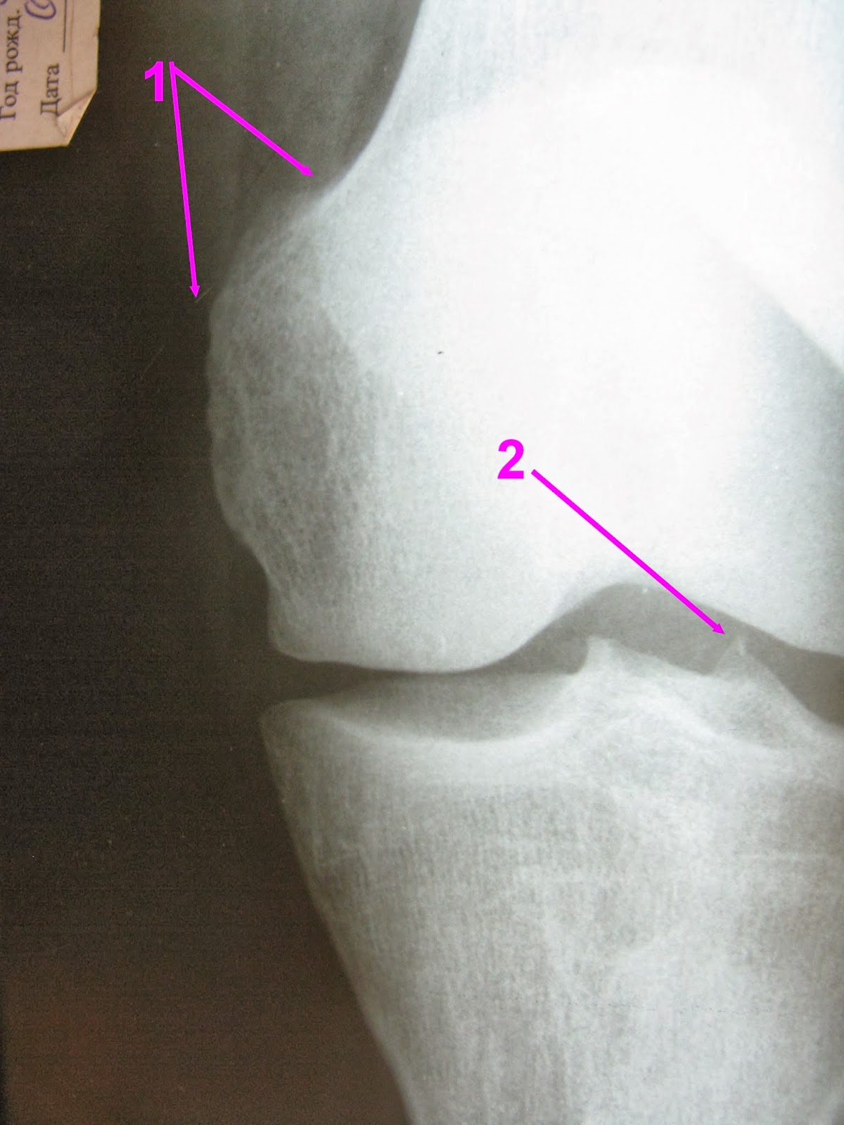 Повреждения мыщелка. Перелом межмыщелкового возвышения рентген. Остеофиты коленного сустава рентген. Краевой перелом межмыщелкового возвышения большеберцовой кости. Межмыщелковое возвышение коленного сустава.