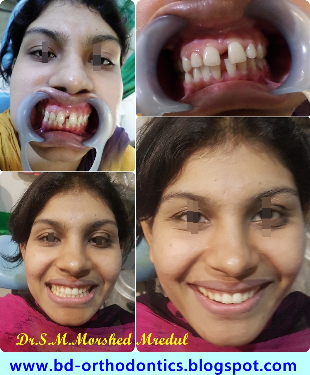 Orthodontics Gallery Non extraction modern Orthodontics Treatment