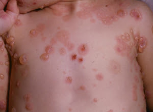 Foto Obat Alami Gatal Gatal Eksim Basah Paling Manjur