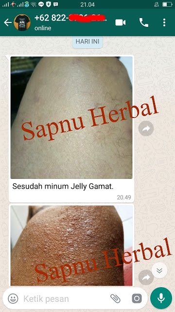 Cara Menghilangkan Bekas Koreng Yang Sudah Lama dan Menghitam Sampai Tuntas Cara Menghilangkan Bekas Koreng Yang Sudah Lama dan Menghitam Sampai Tuntas