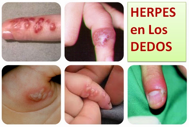 Herpes-en-las-manos-tratamiento-dedos