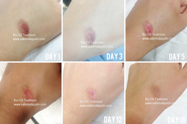 zijn Automatisch genezen Bio Oil Review on my burned scar | Sabrina Tajudin | Malaysia Beauty &  Lifestyle Blog