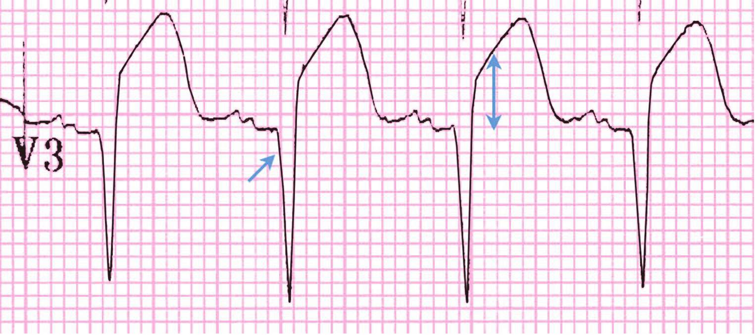 Study Medical Photos Acute Anterior Myocardial Infarction ECG