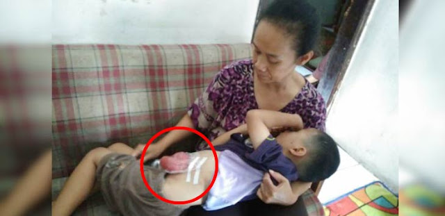 Yusa, Bocah 6 Tahun ini Hidup dengan Usus Diluar Perut Dibungkus Plastik Selama 6 Bulan Yusa, Bocah 6 Tahun ini Hidup dengan Usus Diluar Perut Dibungkus Plastik Selama 6 Bulan